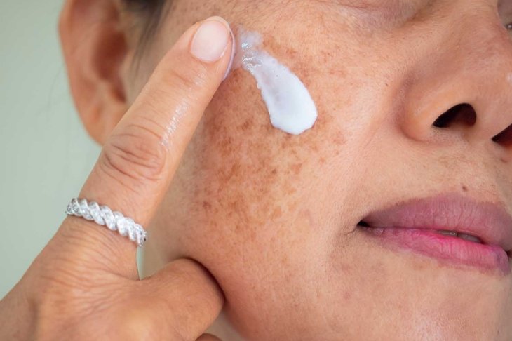 Asian woman are applying cream for facial treatment problem spot melasma pigmentation skincare on her face.